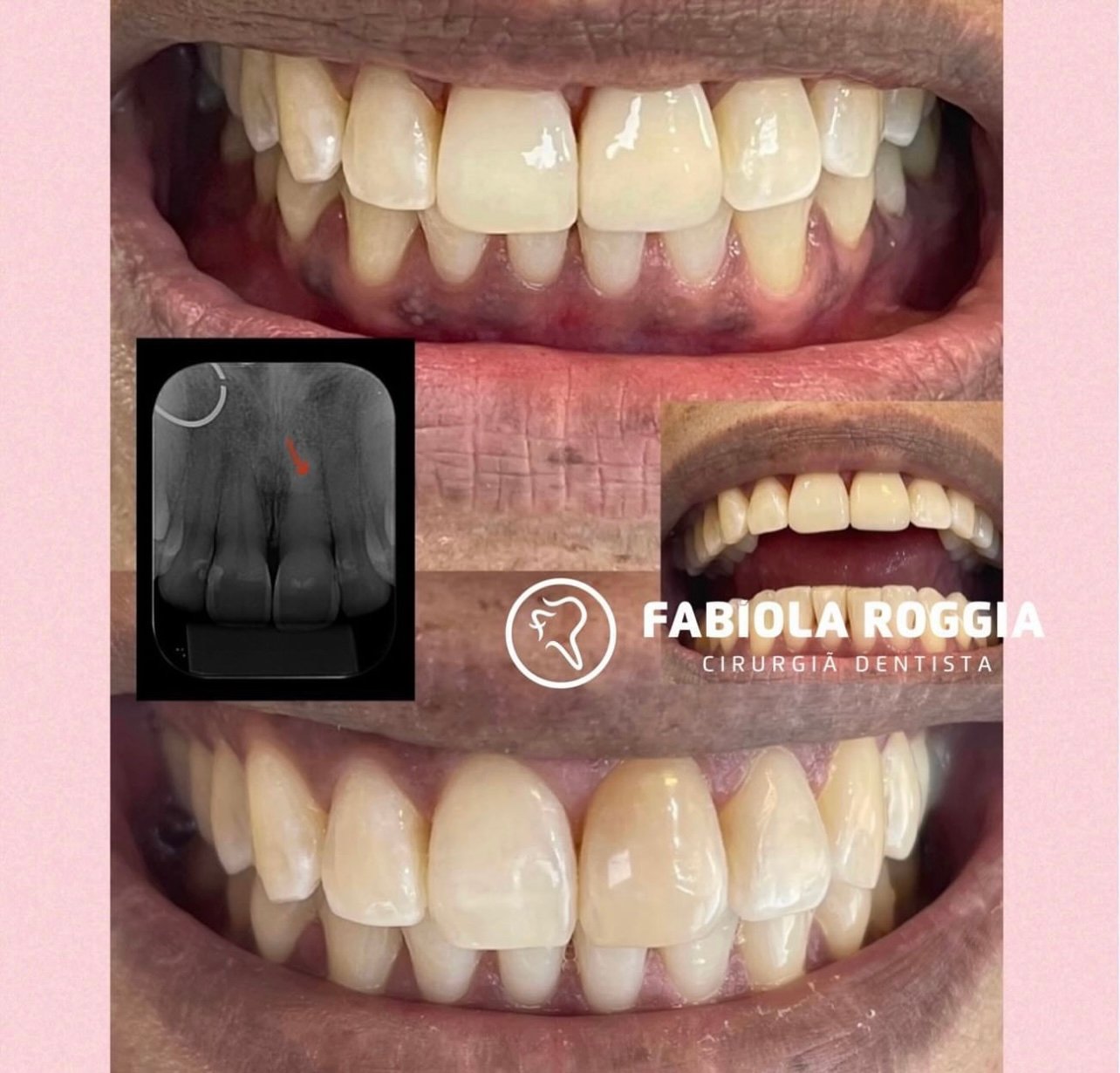 Clareamento dentário