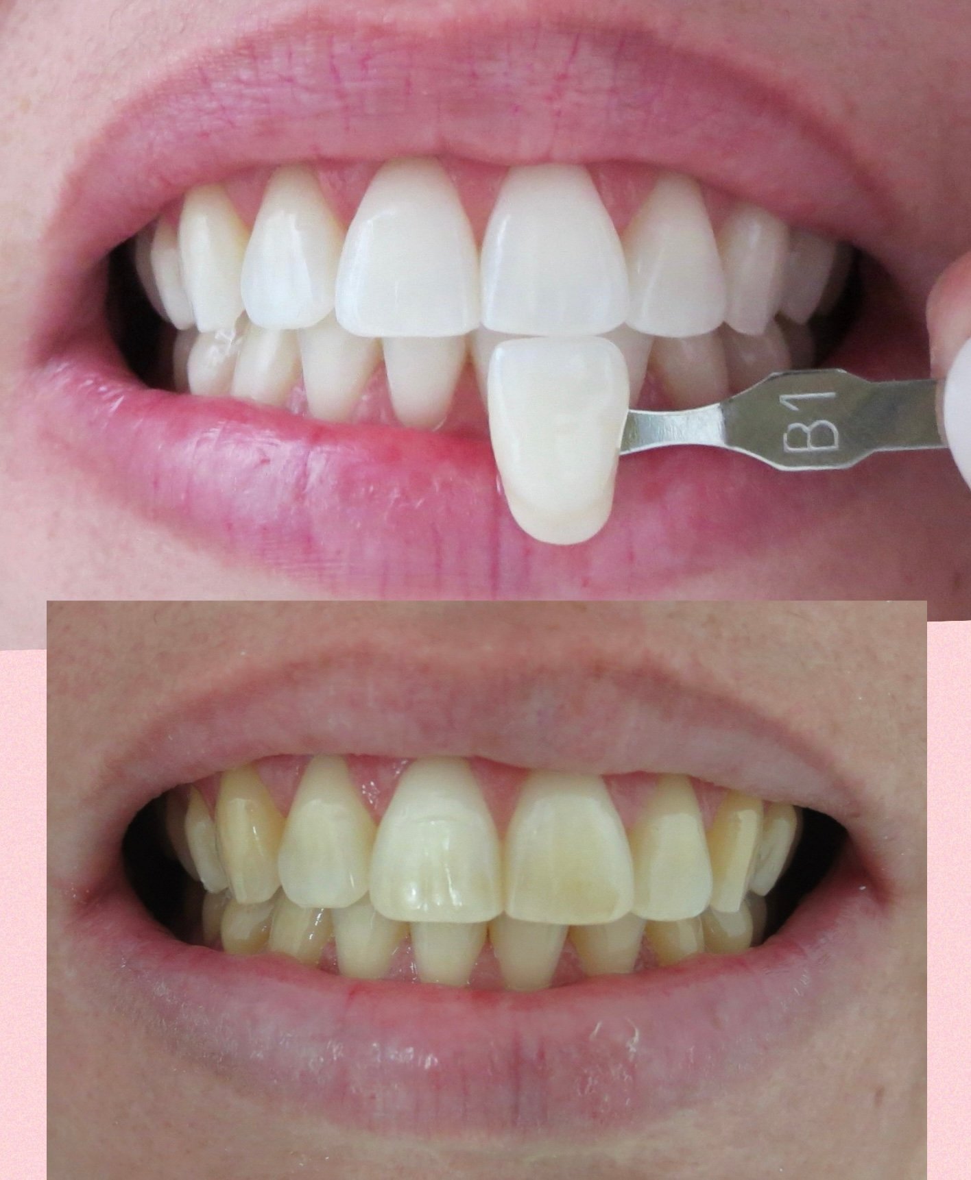 Clareamento dentário