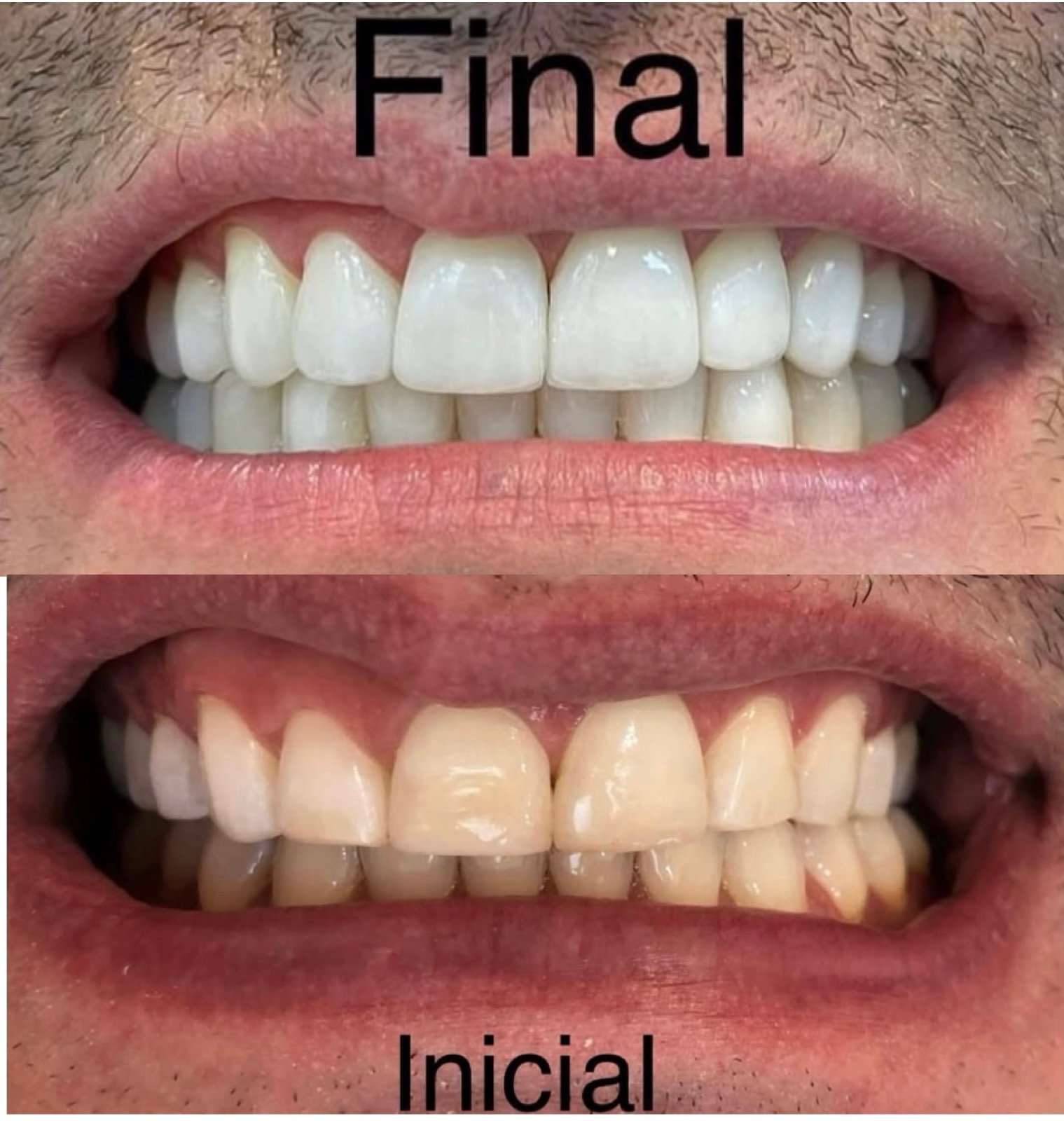 Facetas-resina composta