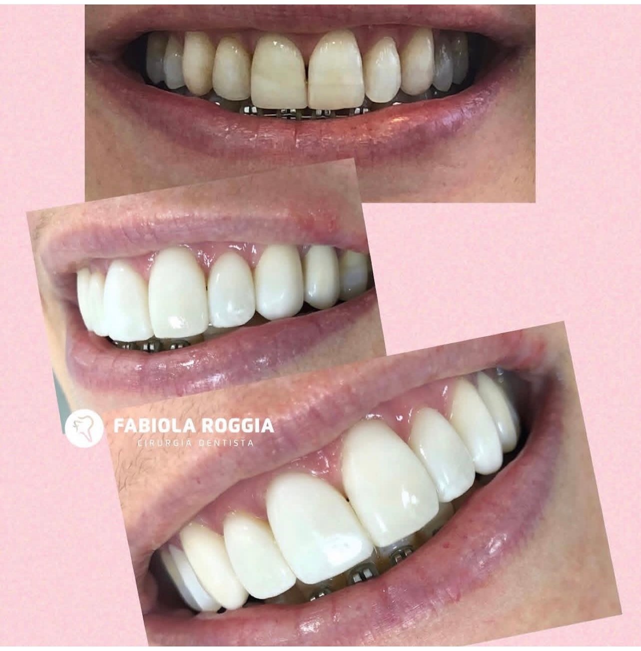 Facetas-resina composta