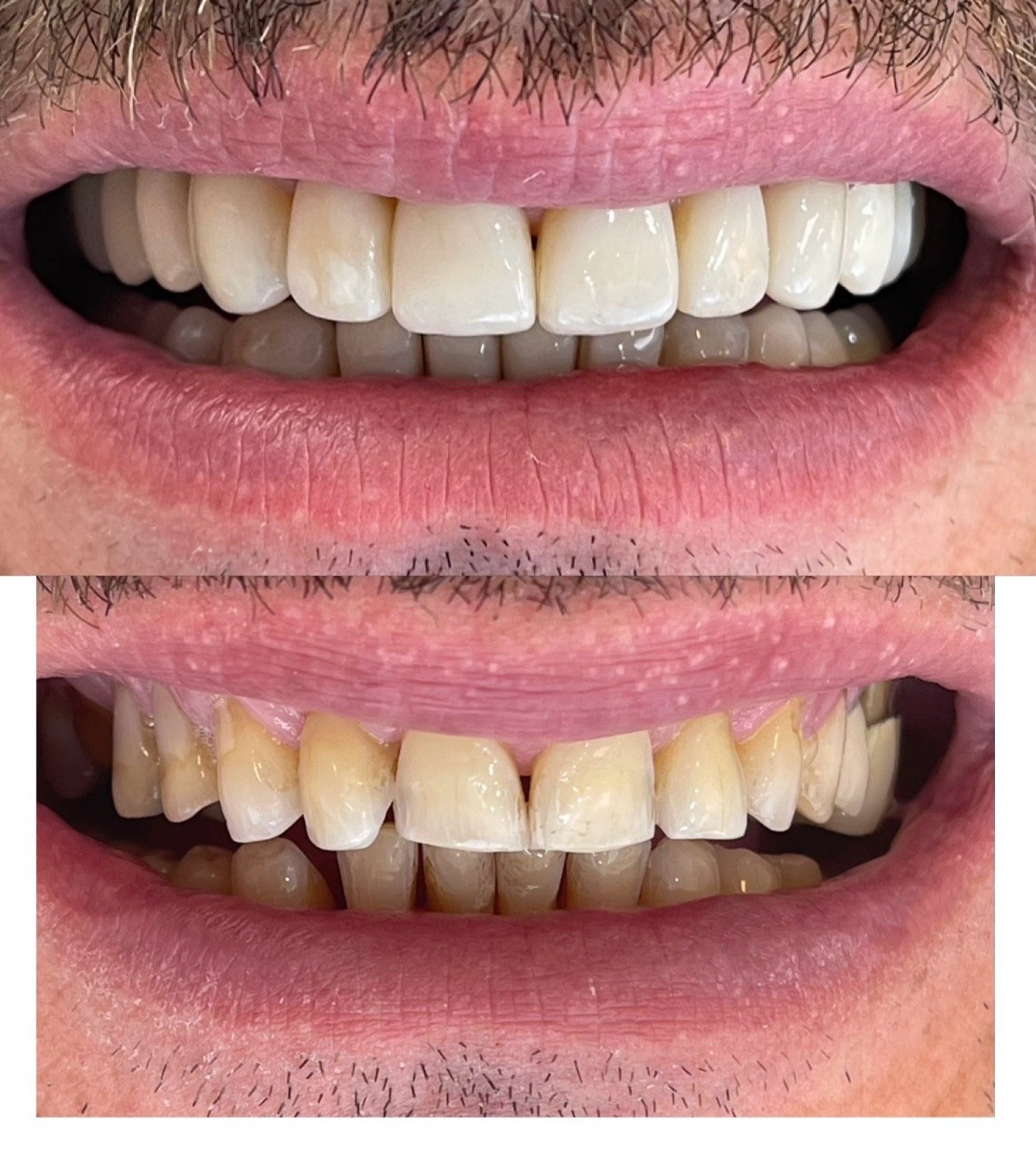 Facetas-resina composta