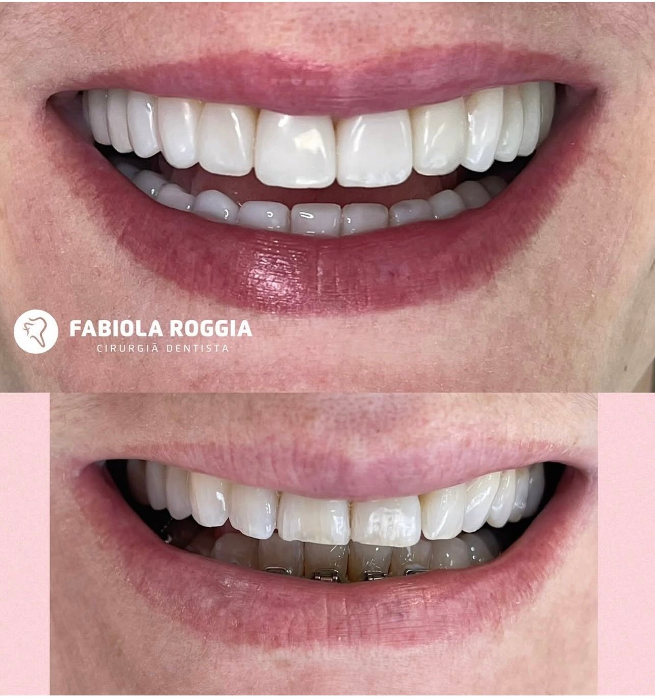 Facetas-resina composta