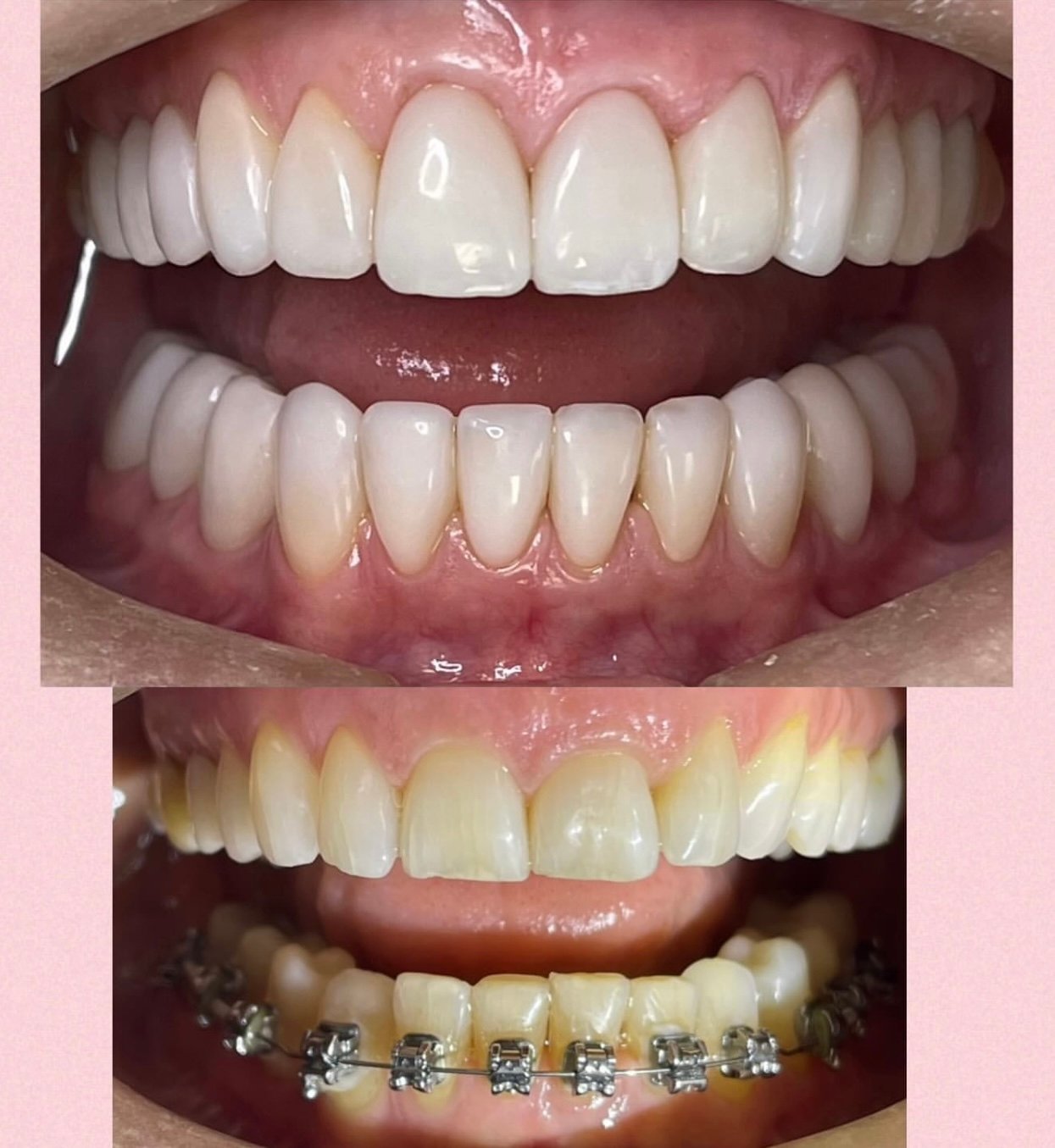 Facetas-resina composta