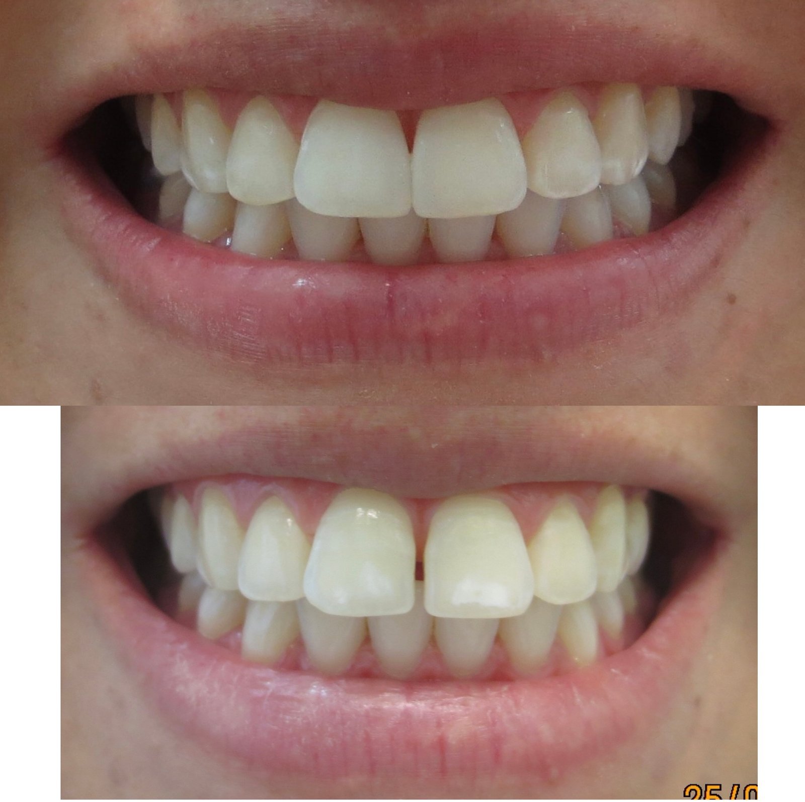 Fechamento de Diastema