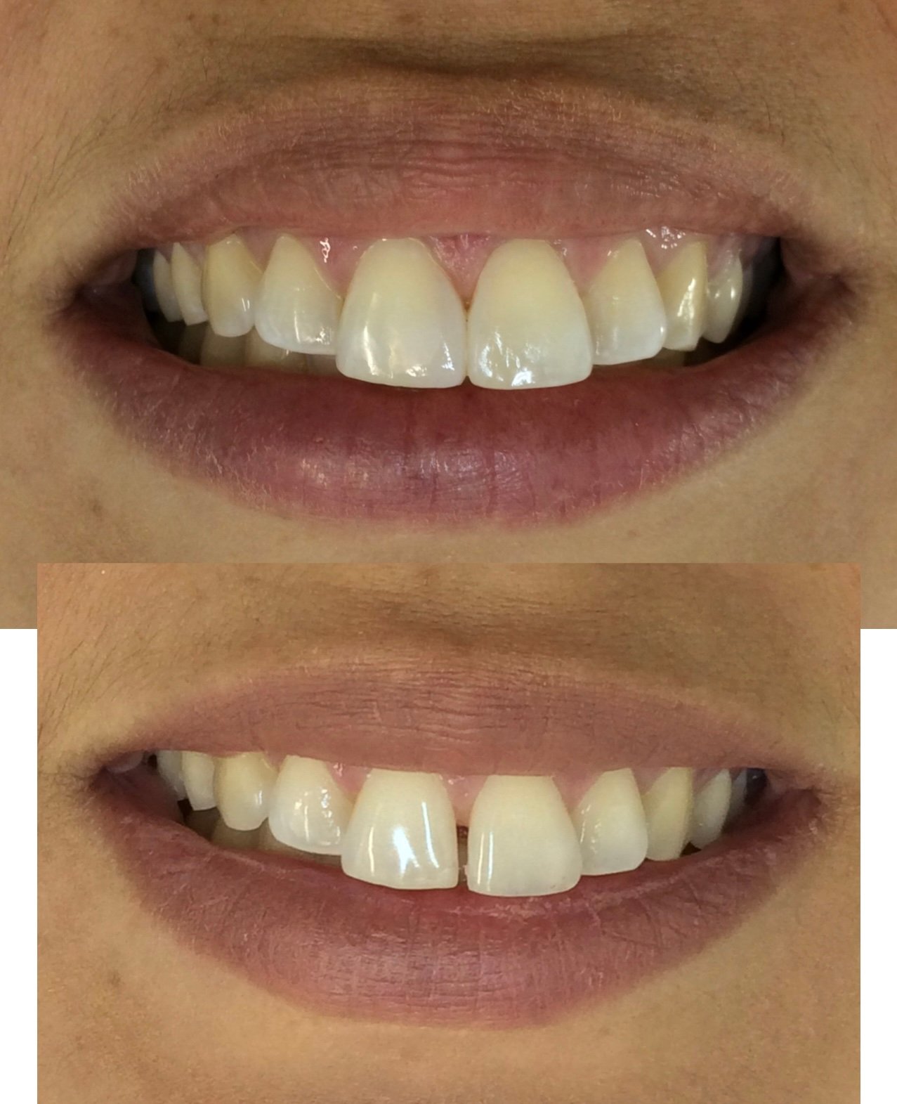 Fechamento de Diastema