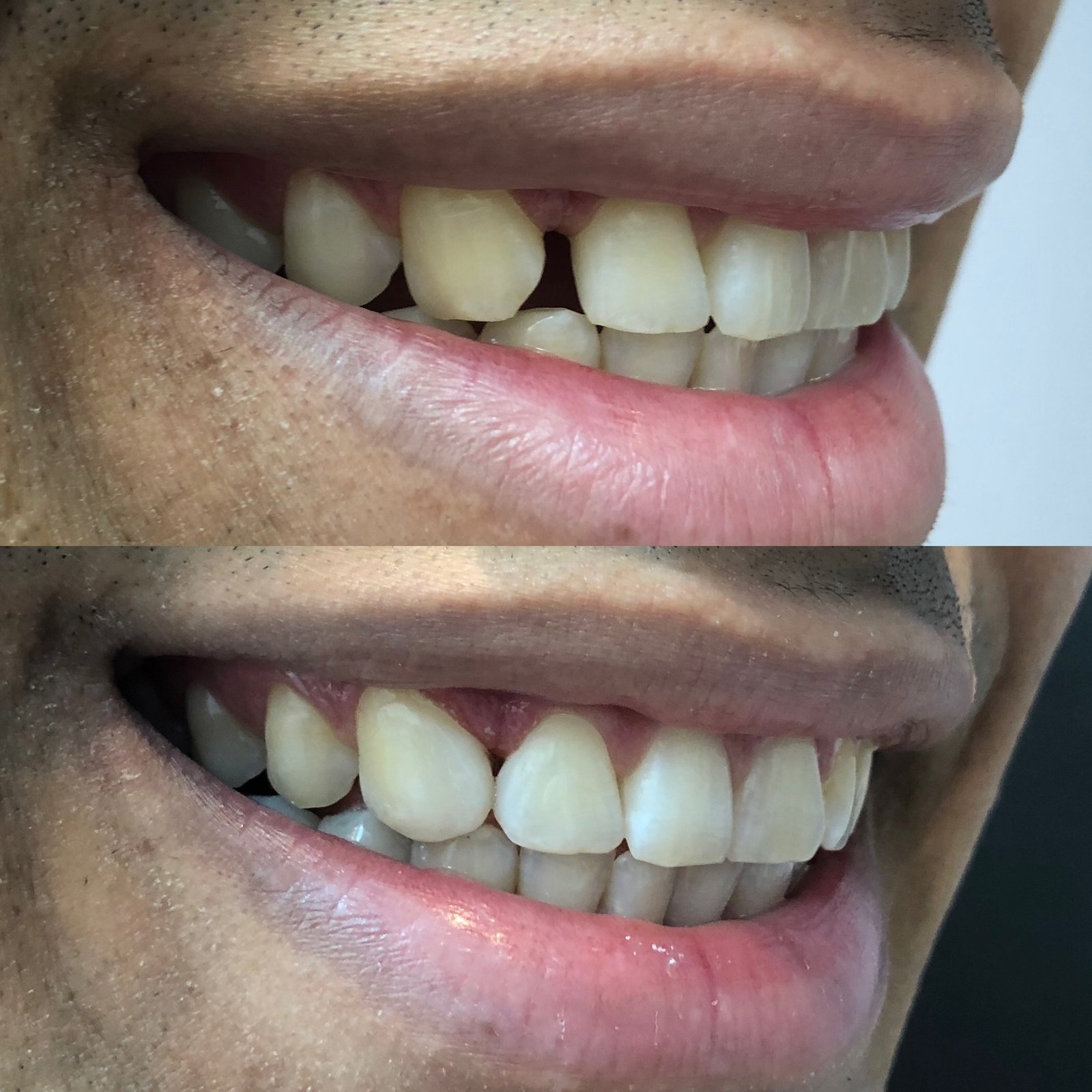 Fechamento de Diastema