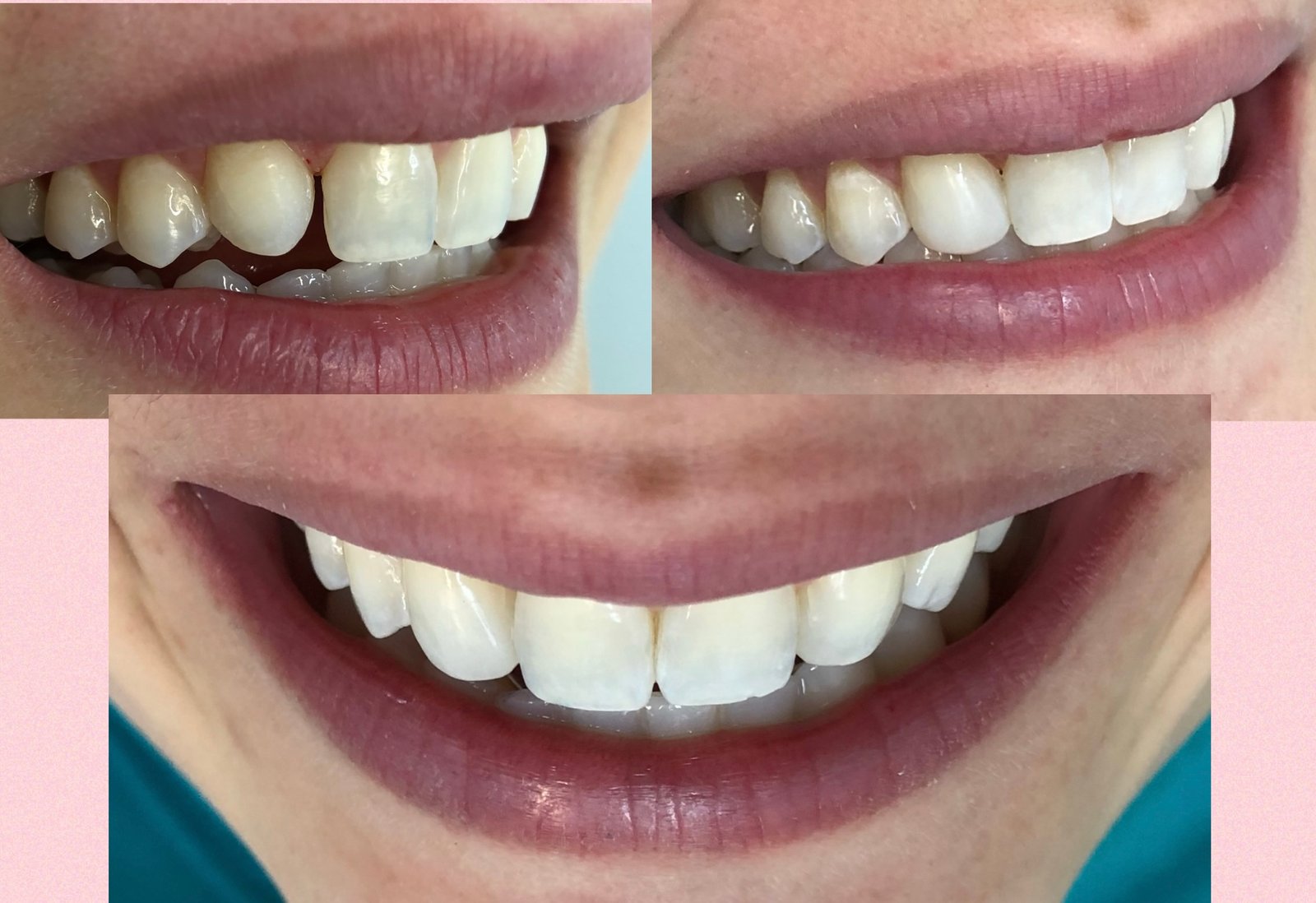 Fechamento de diastema