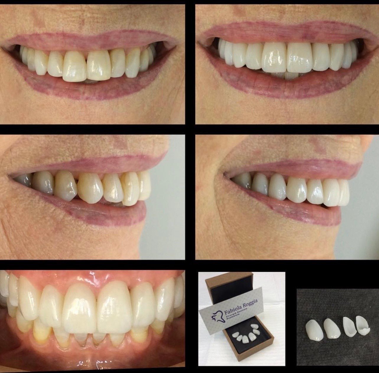 Lentes/facetas cerâmicas