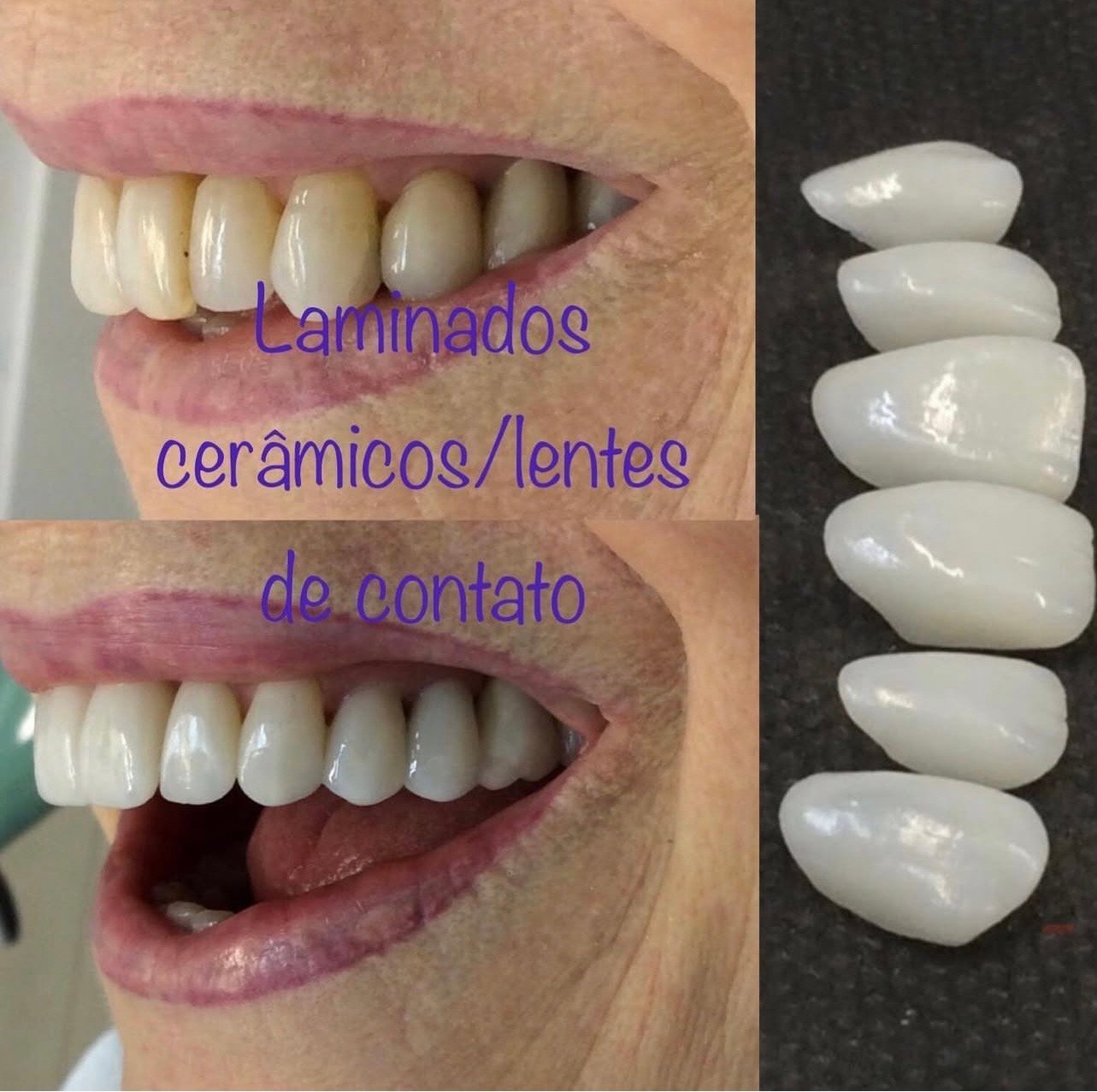 Lentes/facetas cerâmicas