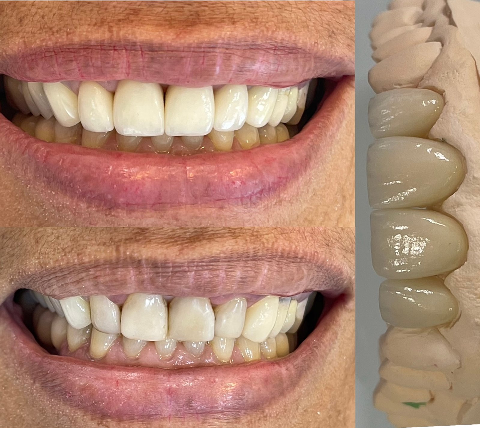 Lentes/facetas cerâmicas