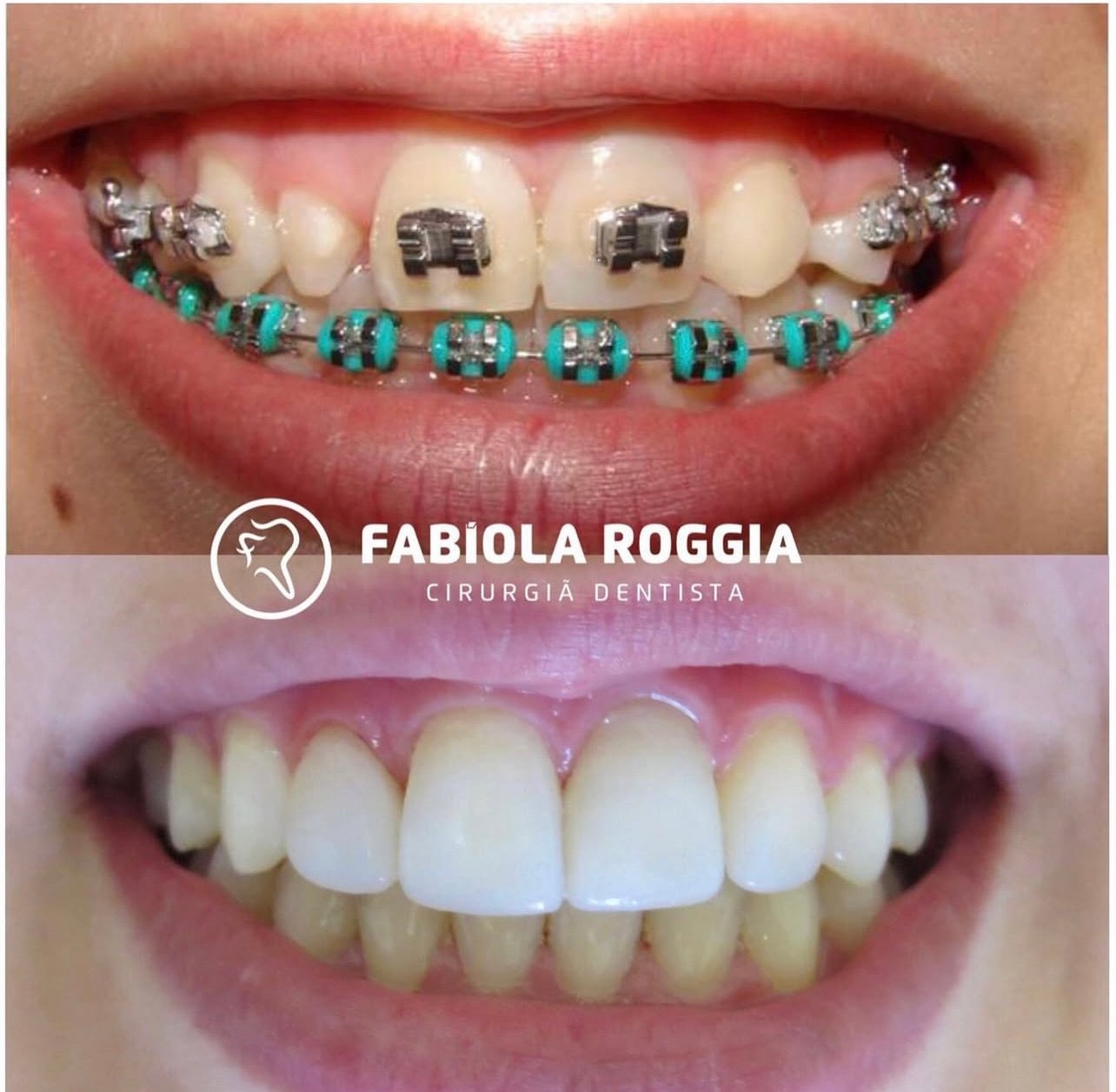 Plástica gengival-reanatomização