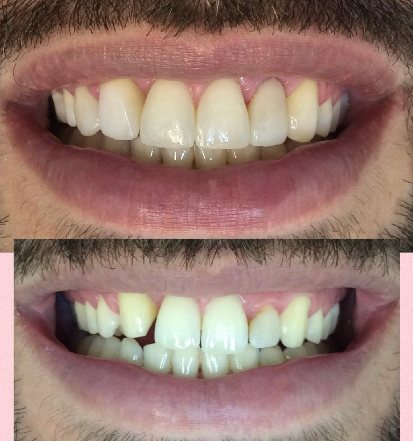 Plástica gengival-reanatomização