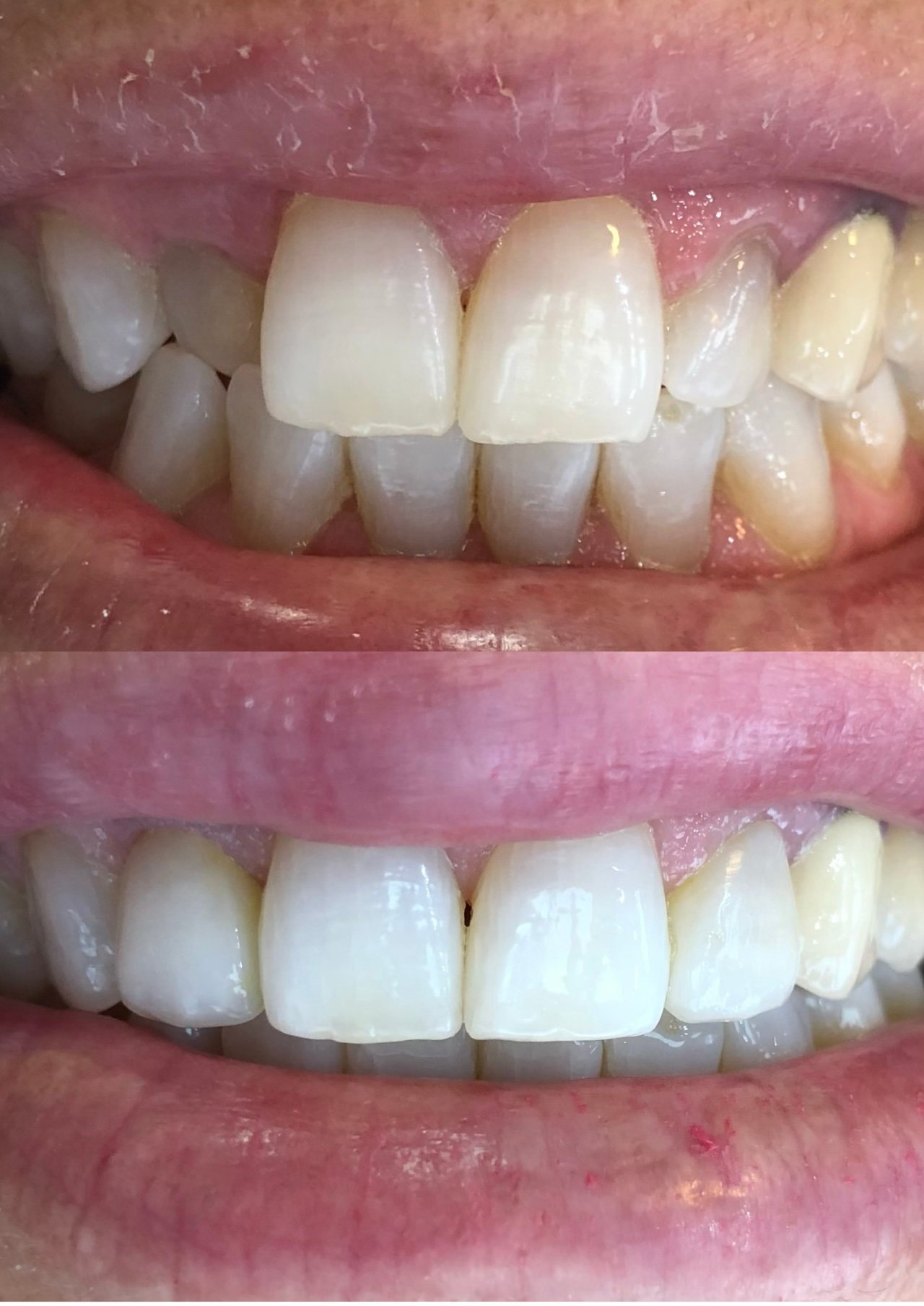 Plástica gengival-reanatomização