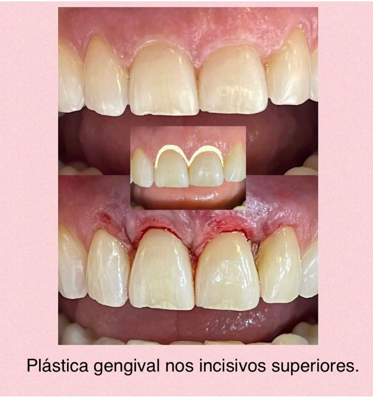 Plástica gengival-reanatomização