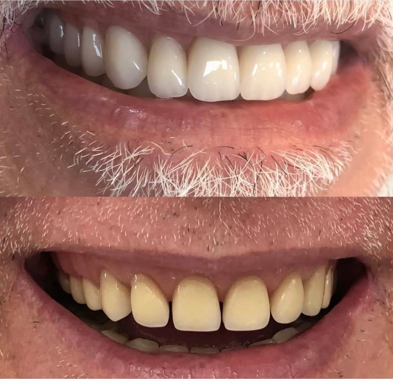 Prótese total convencional