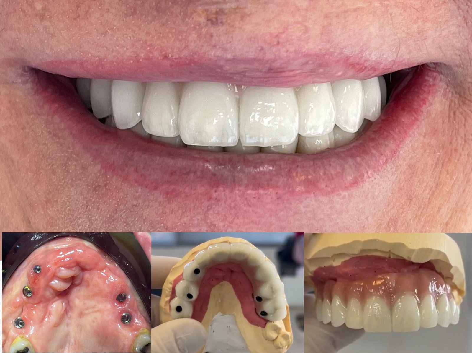 Prótese total protocolo