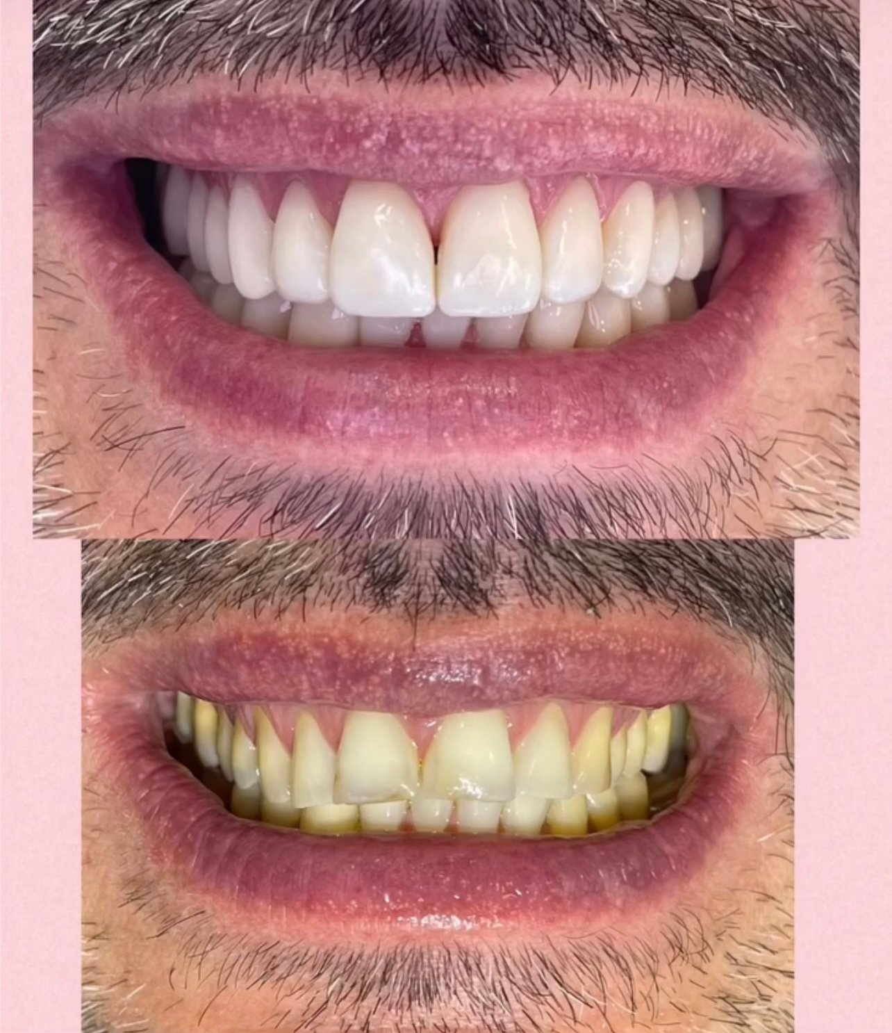 Reabilitação estética-oclusal