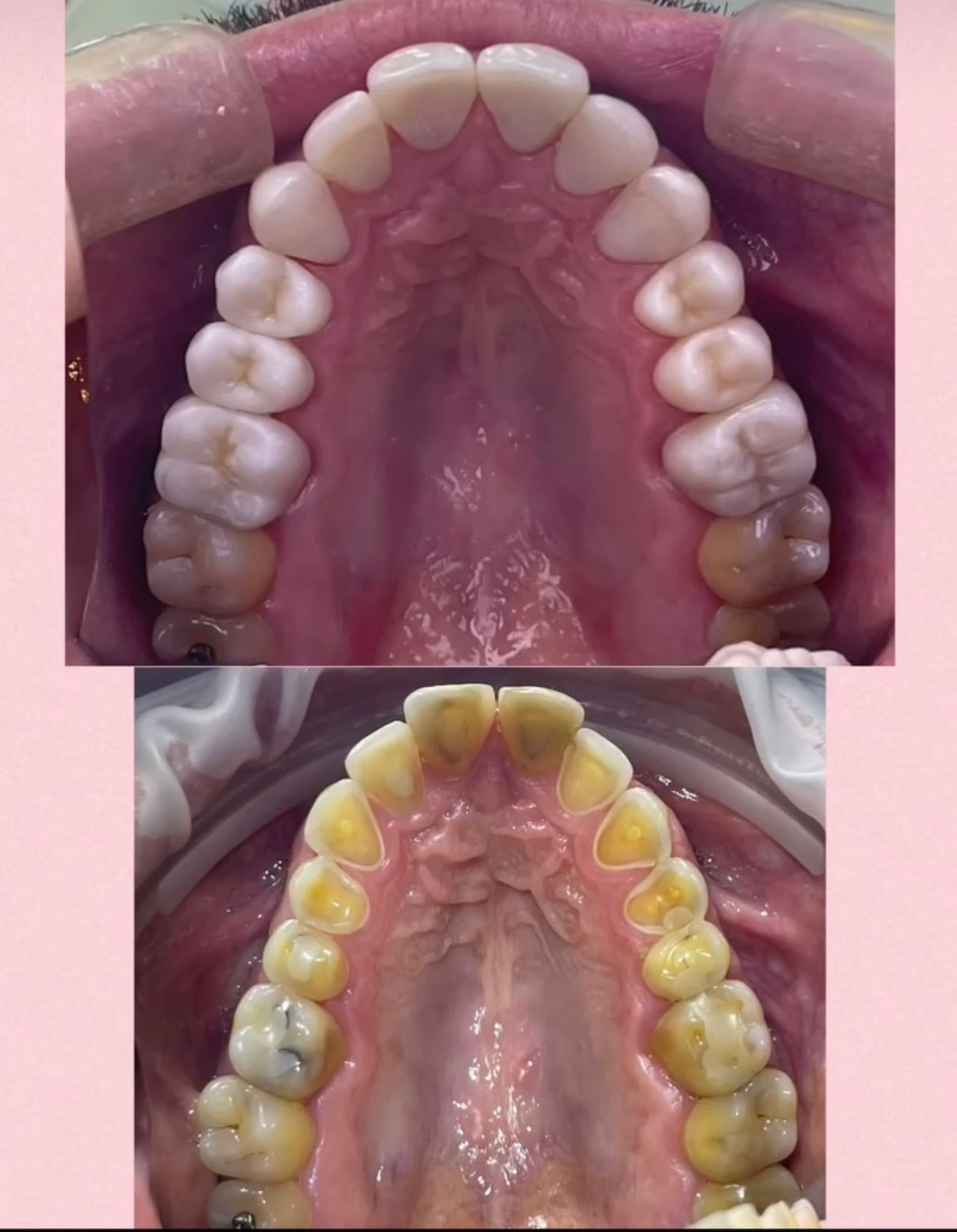 Reabilitação estética-oclusal