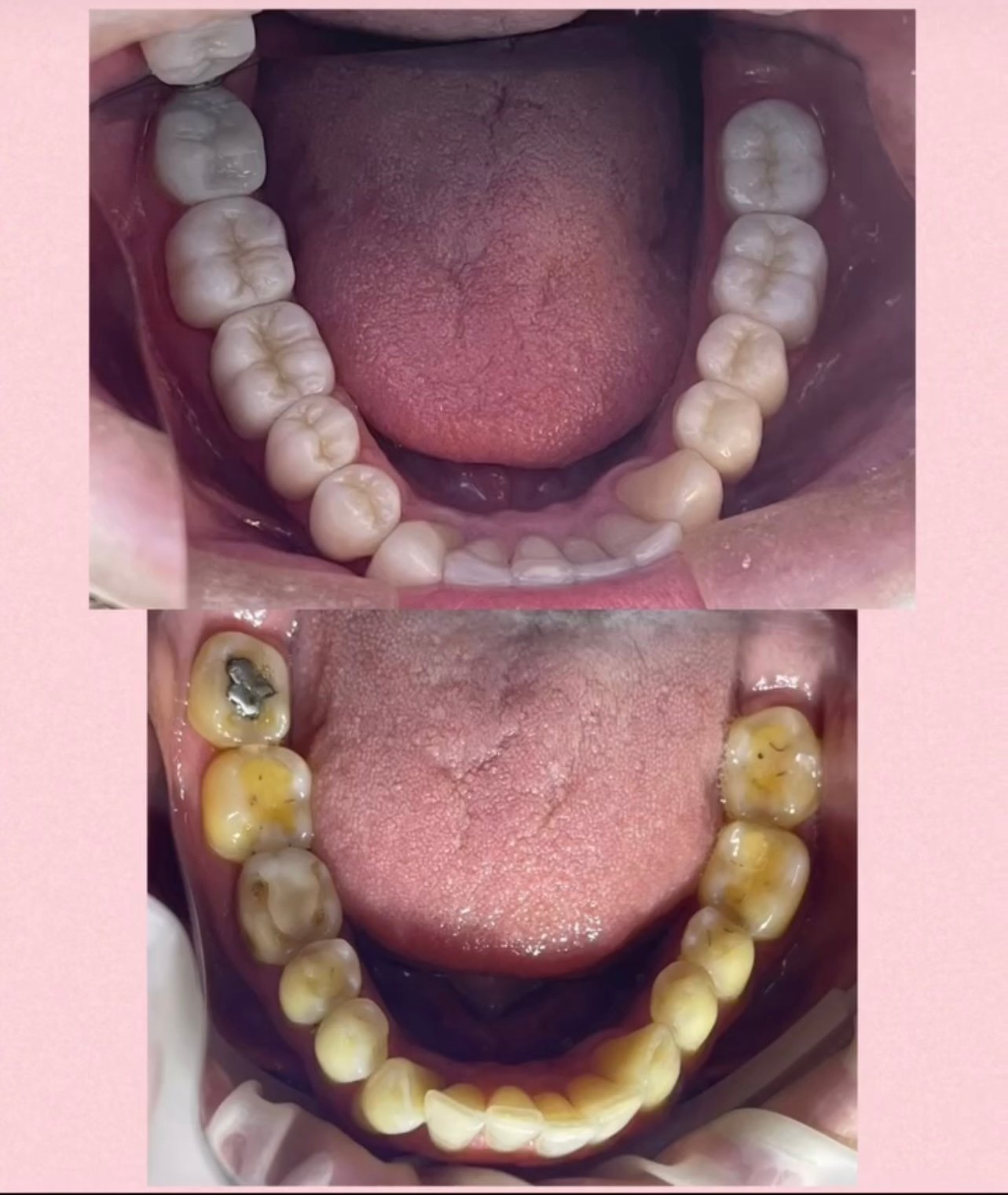 Reabilitação estética-oclusal
