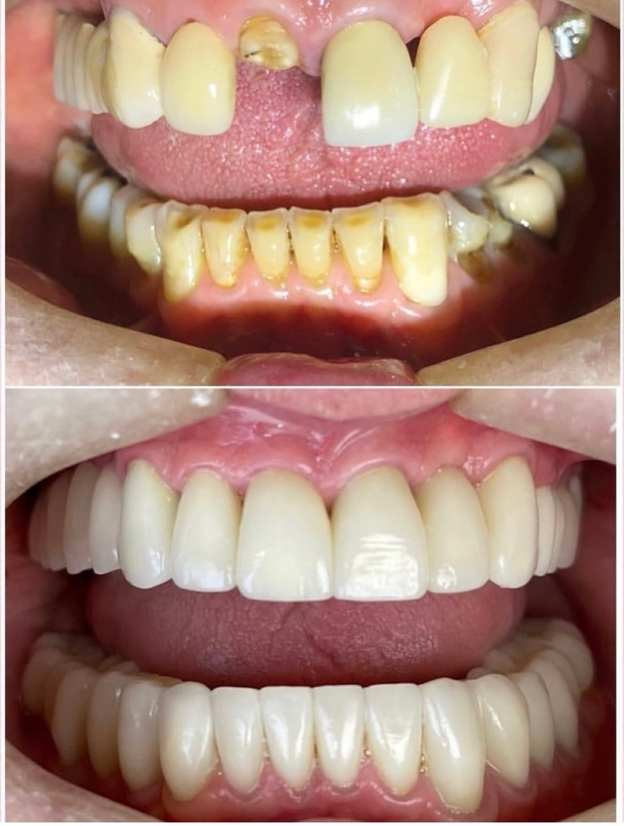 Reabilitação estética-oclusal