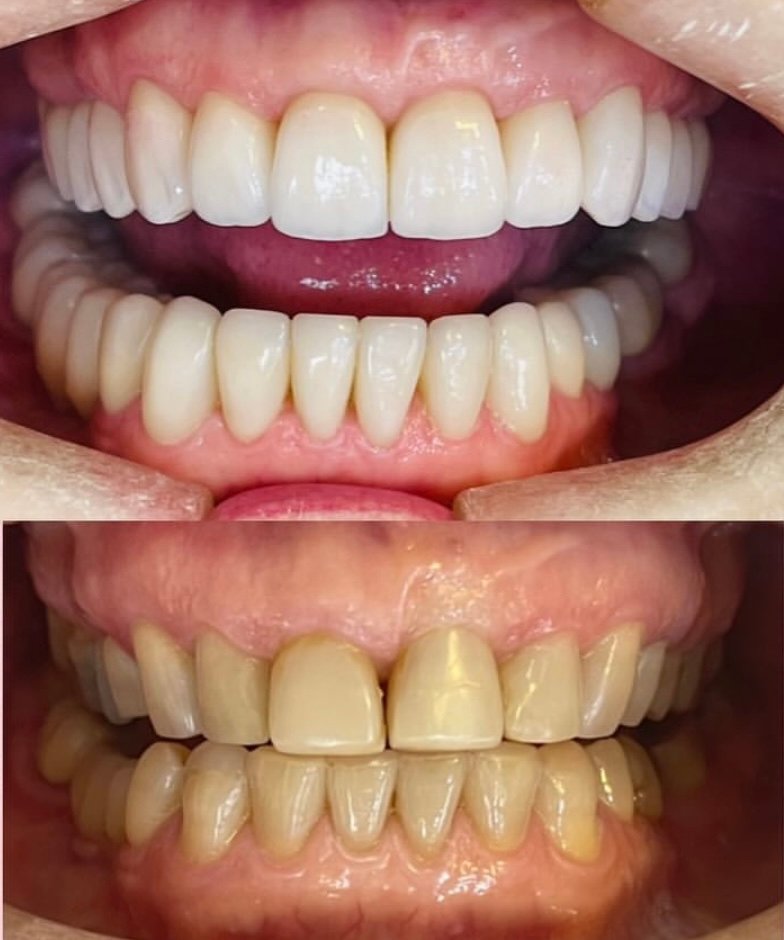 Reabilitação estética-oclusal