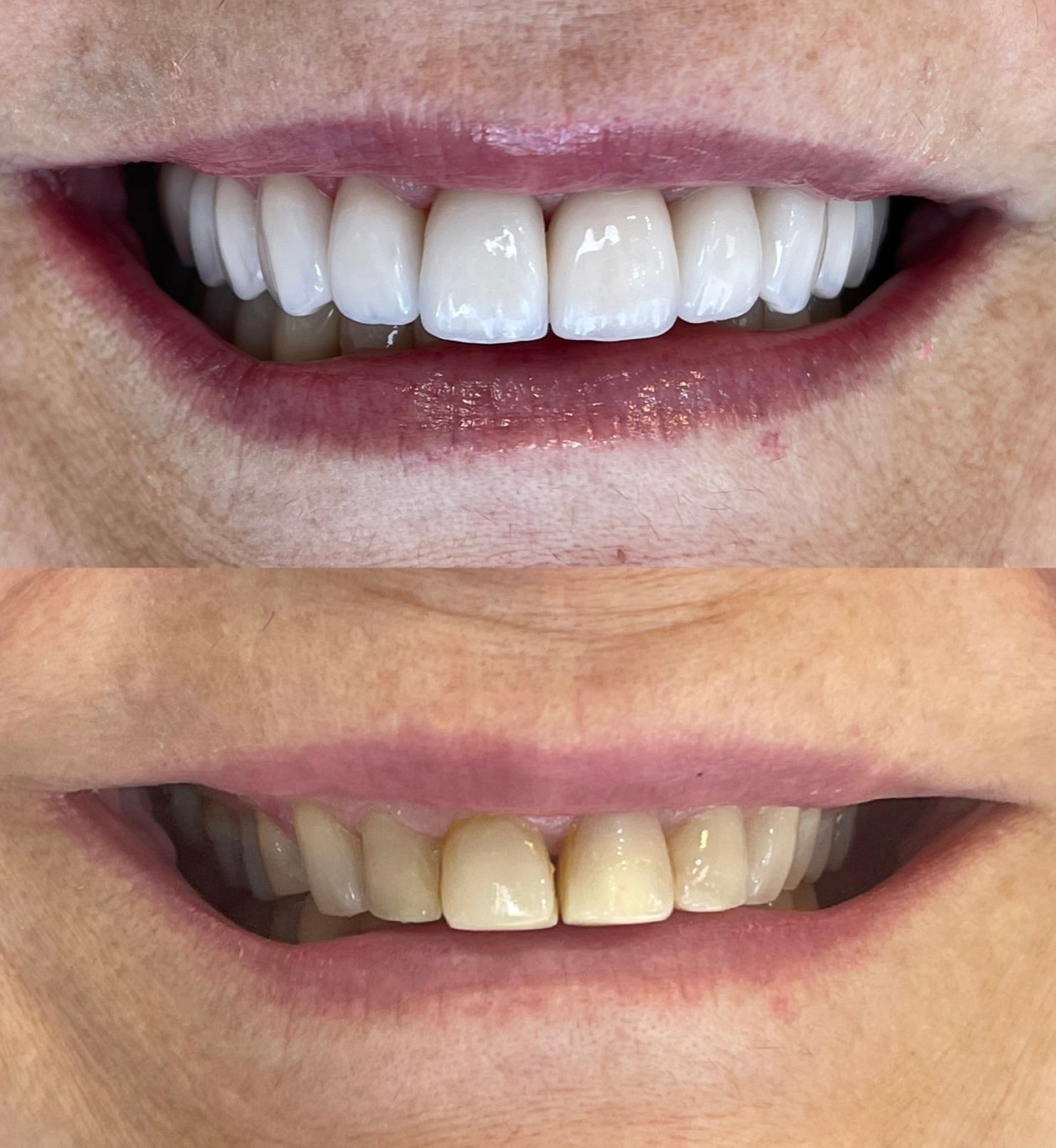 Reabilitação estética-oclusal