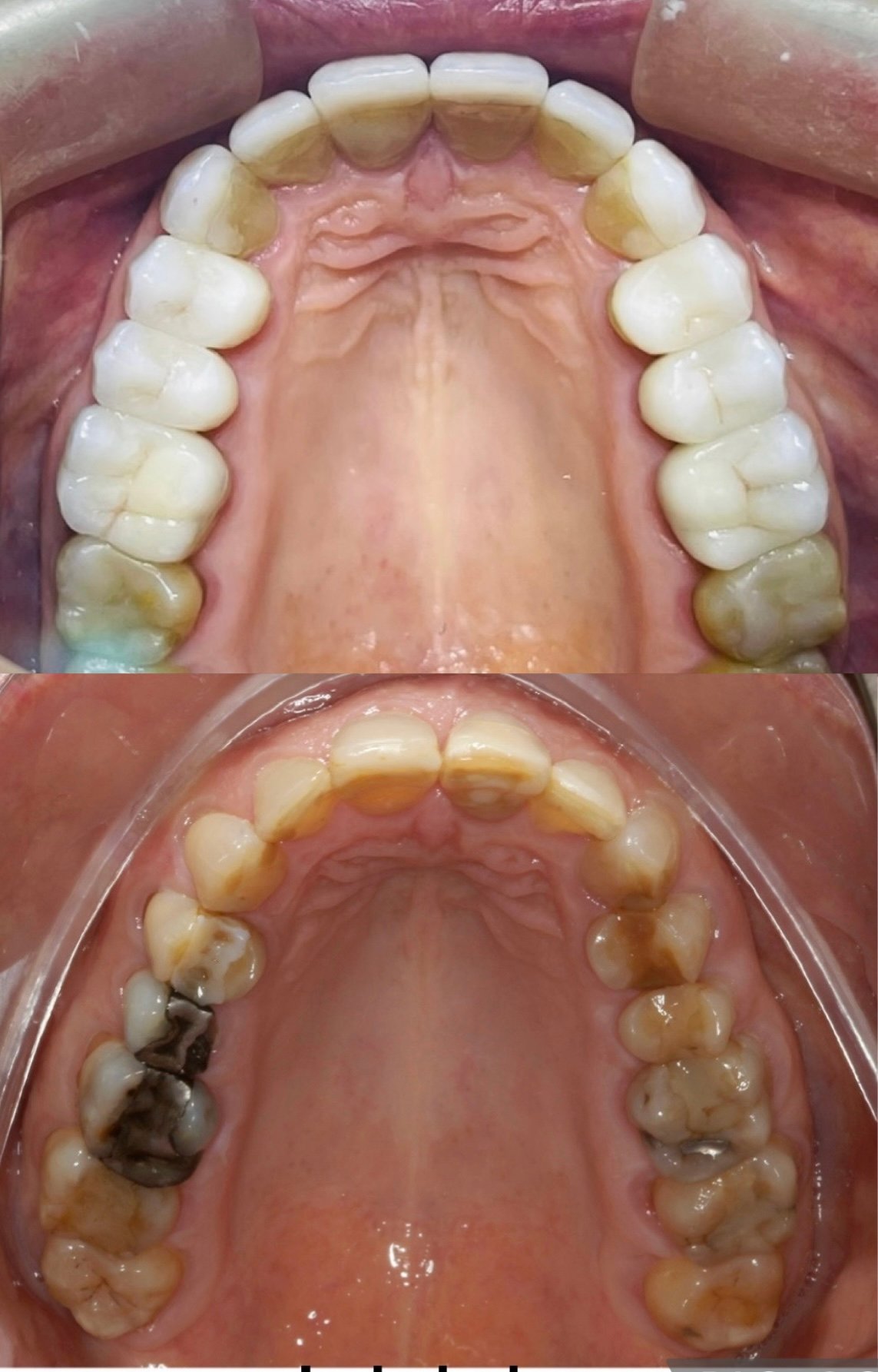 Reabilitação estética-oclusal