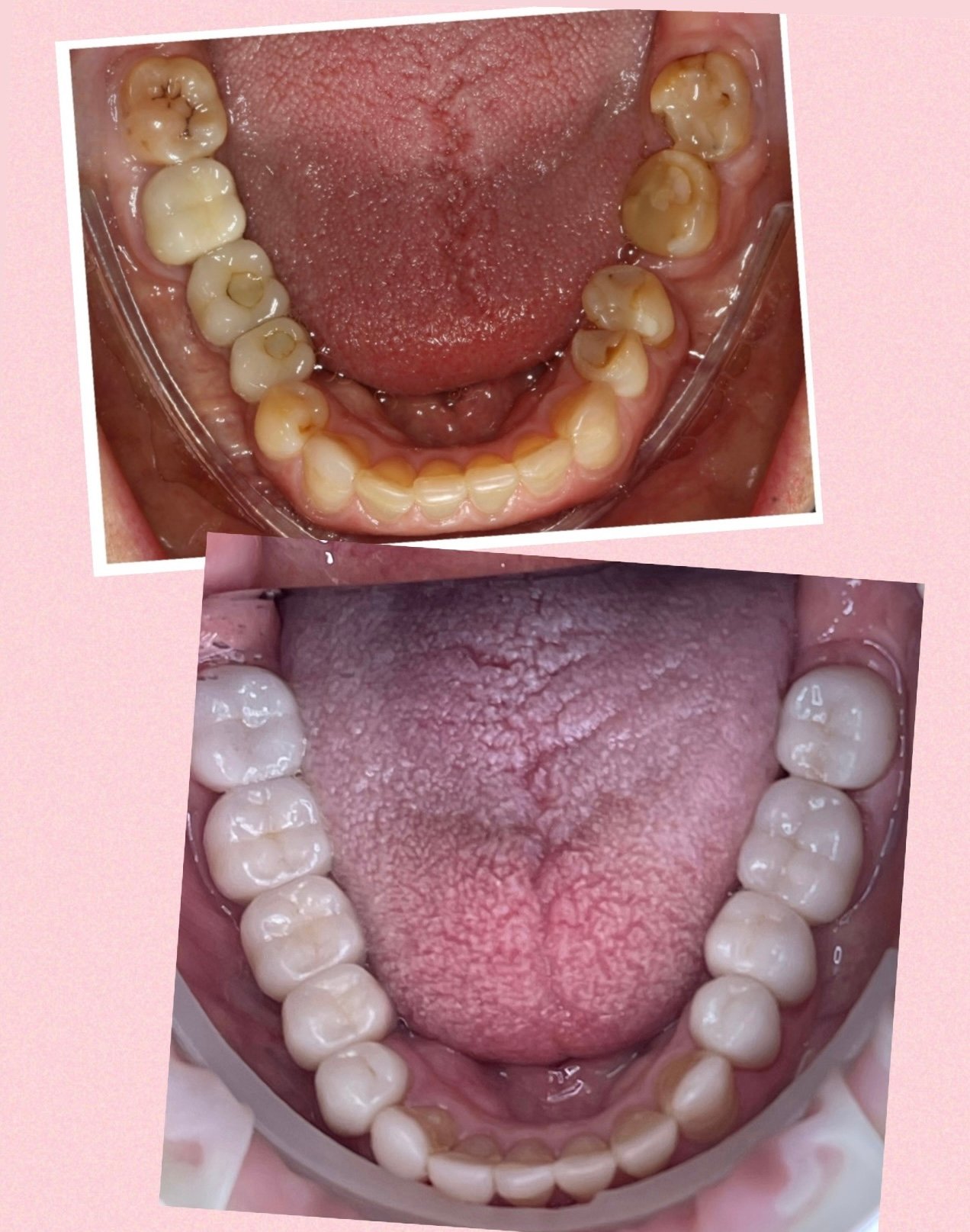 Reabilitação estética-oclusal