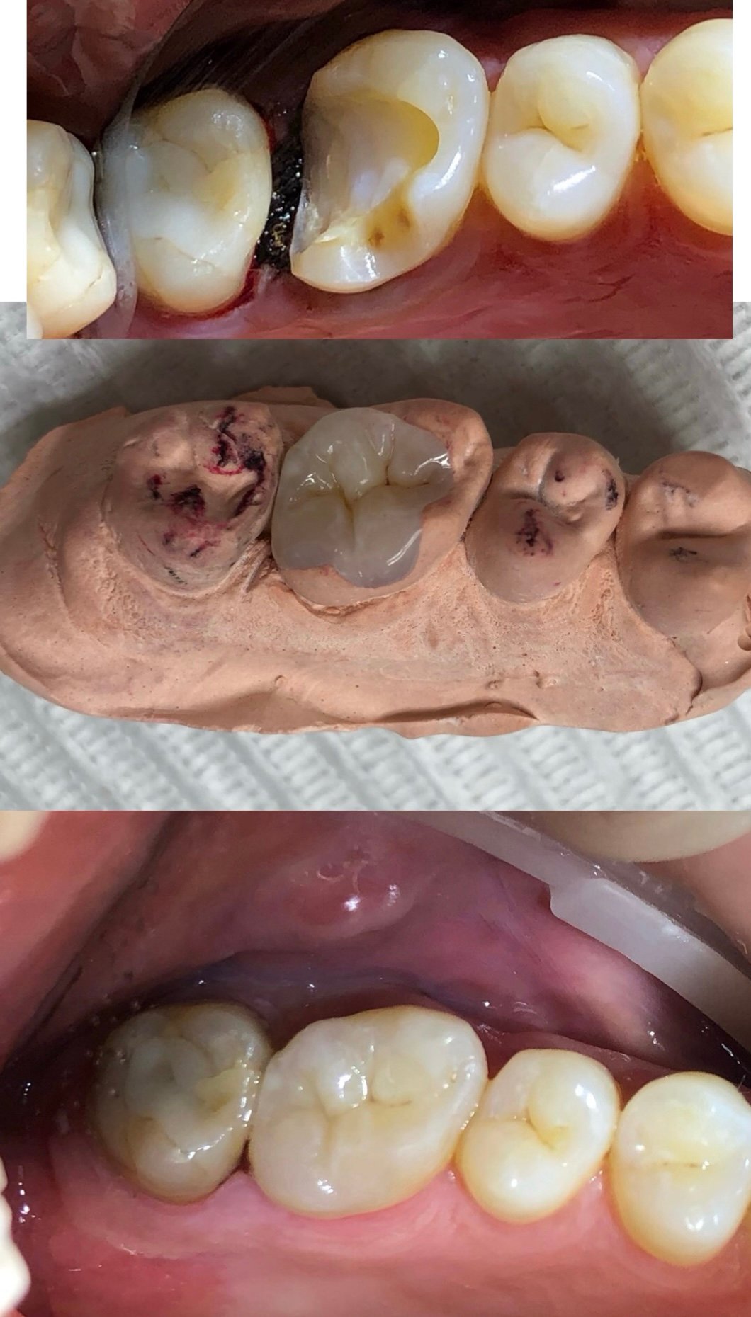 Restauração indireta