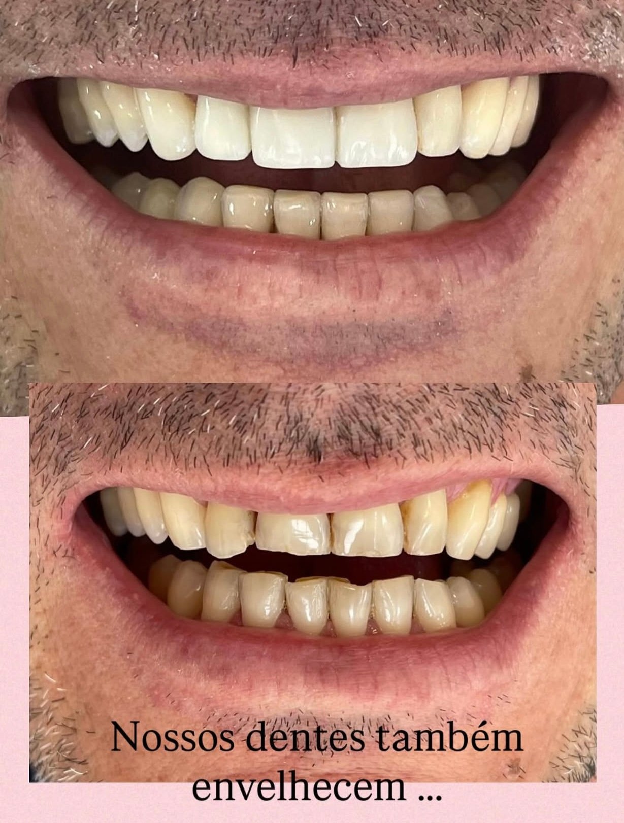 Restauracões estéticas