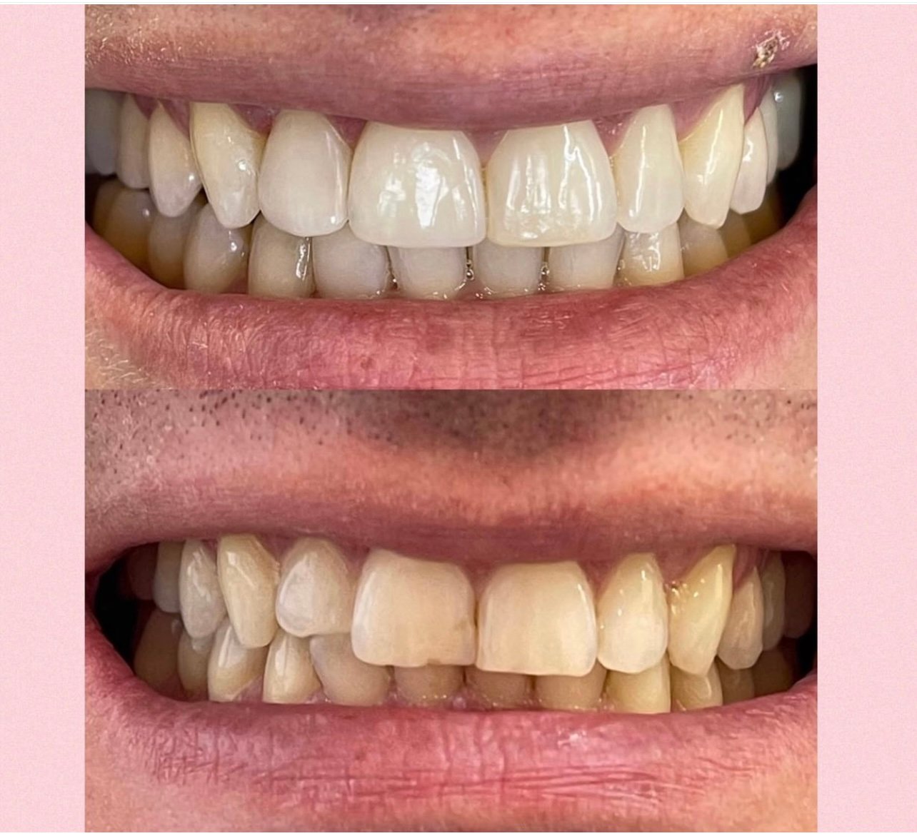 Restauracões estéticas