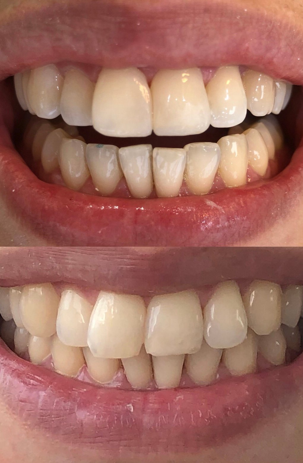 Restauracões estéticas