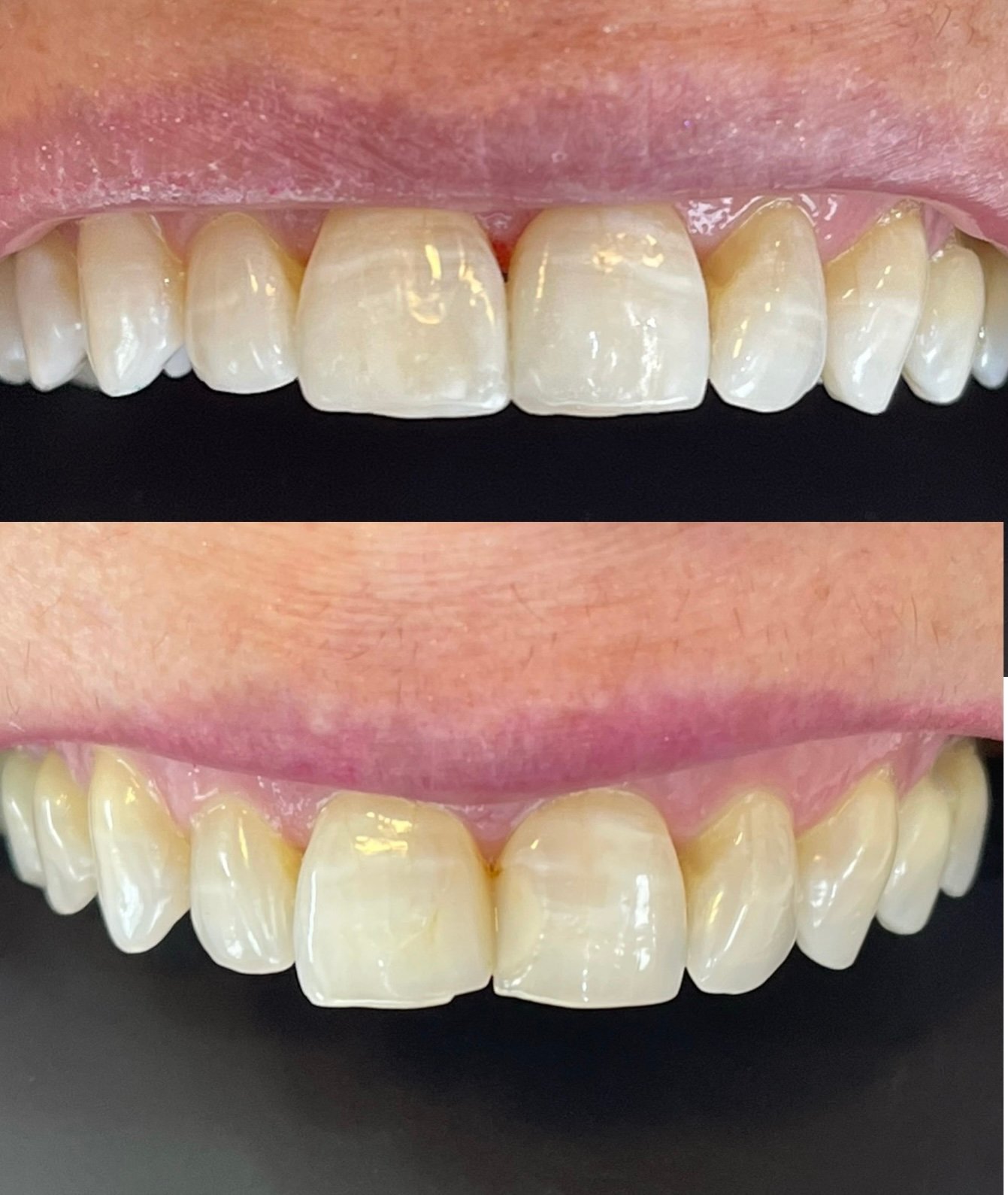 Restauracões estéticas