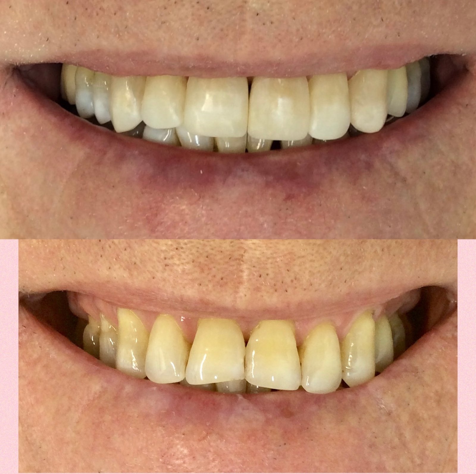 Restauracões estéticas